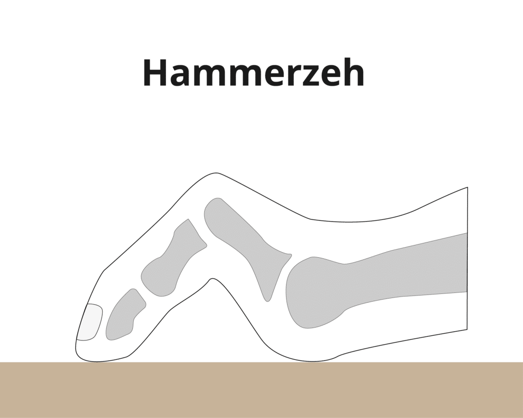 Hammerzeh Abbildung – Dr. Schuh 1190 Wien