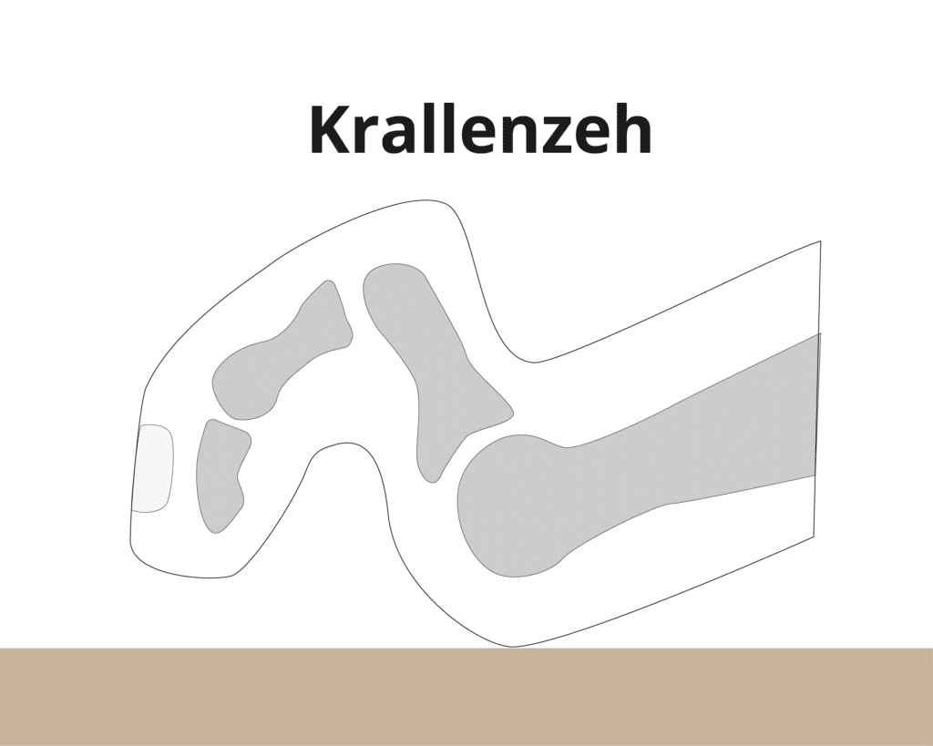 Krallenzeh Abbildung – Dr. Schuh Orthopäde 1190