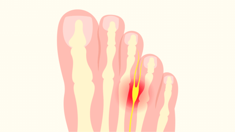 Morton Neurom Grafik zur Darstellung der Erkrankung