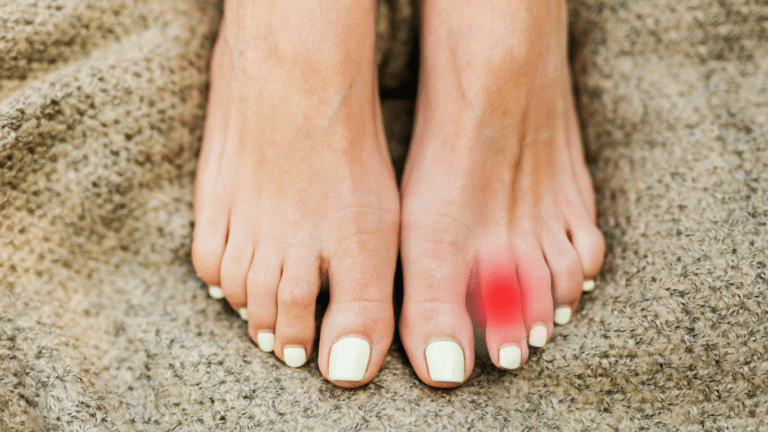 Ein Kapselriss im Zeh äußert sich durch eine deutliche Schwellung, stechende Schmerzen (später pochend) und häufige blaue Flecken um das Gelenk.