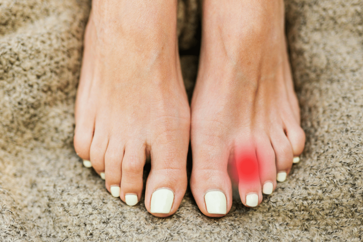 Ein Kapselriss im Zeh äußert sich durch eine deutliche Schwellung, stechende Schmerzen (später pochend) und häufige blaue Flecken um das Gelenk.